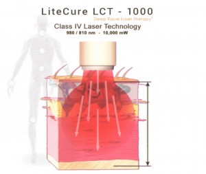 laseroterapia v Bratislave - laser 4.generácie LiteCure LCT - 1000